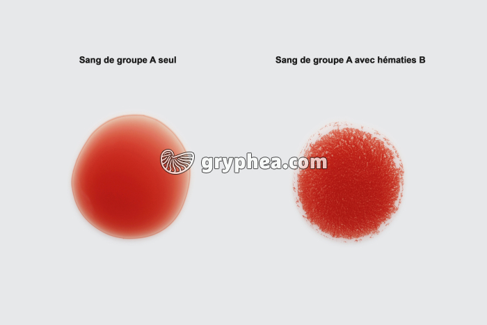 Agglutination des hématies (test de Simonin) - gryphea.com